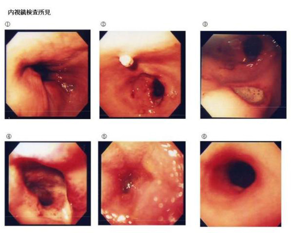 内視鏡検査所見